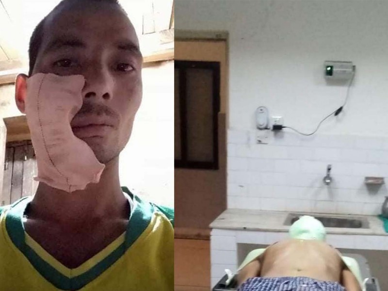 क्यान्सर पिडित सुरेशको उपचारका लागि सहयोग जुट्दै 